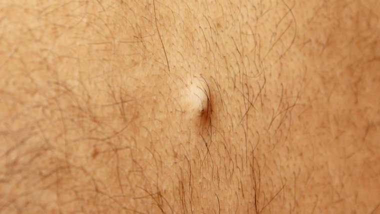 Cisti sebacee cuoio capelluto: cosa sono e come rimuoverle