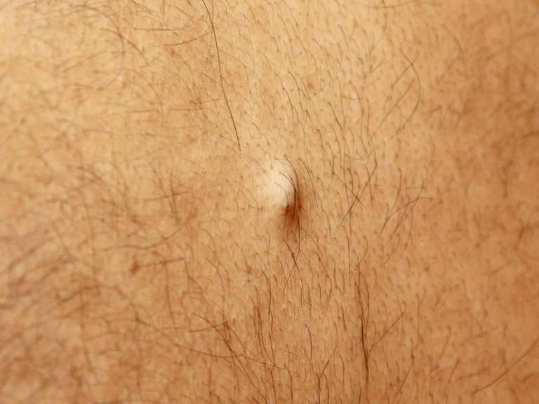 Veruci Sebacee Sebaceous scalp cysts: what they are and how to remove them ...