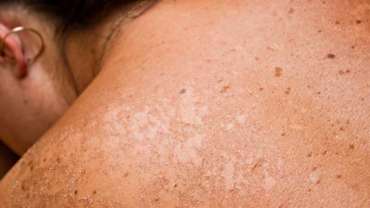 Dermatite solare: cause e prevenzione
