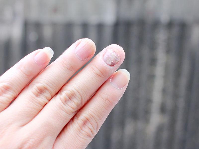 Malattia delle unghie
