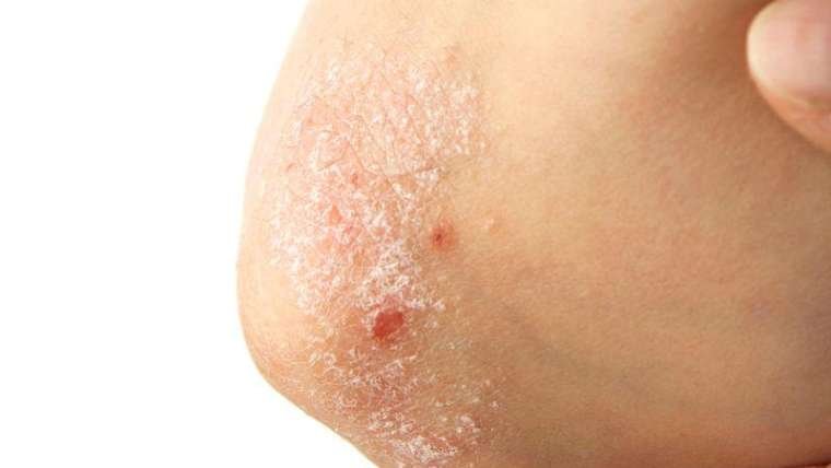 Sintomi della psoriasi: diagnosi e trattamento della patologia