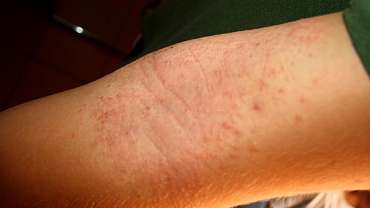 Dermatite atopica adulti: cause, manifestazioni e trattamento