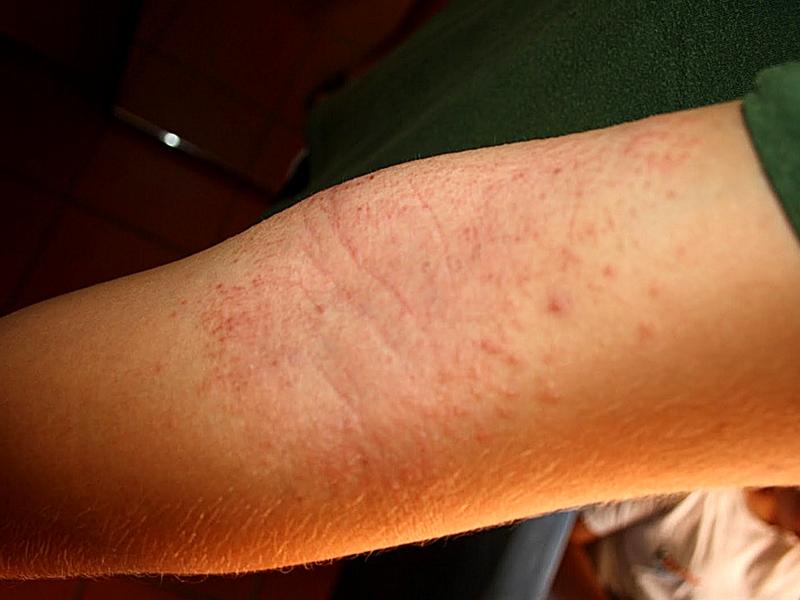 Dermatite atopica adulti: cause, manifestazioni e trattamento