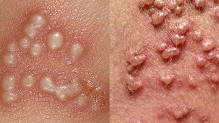 Herpes genitale: cos’è, come si contrae e come curarlo