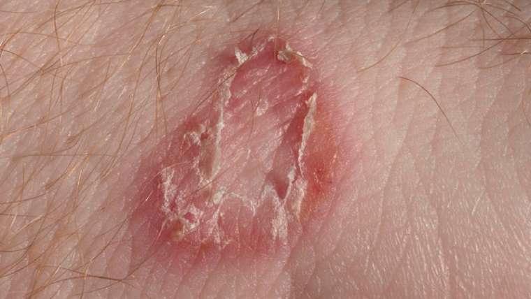 Micosi della pelle: come riconoscerle e curarle