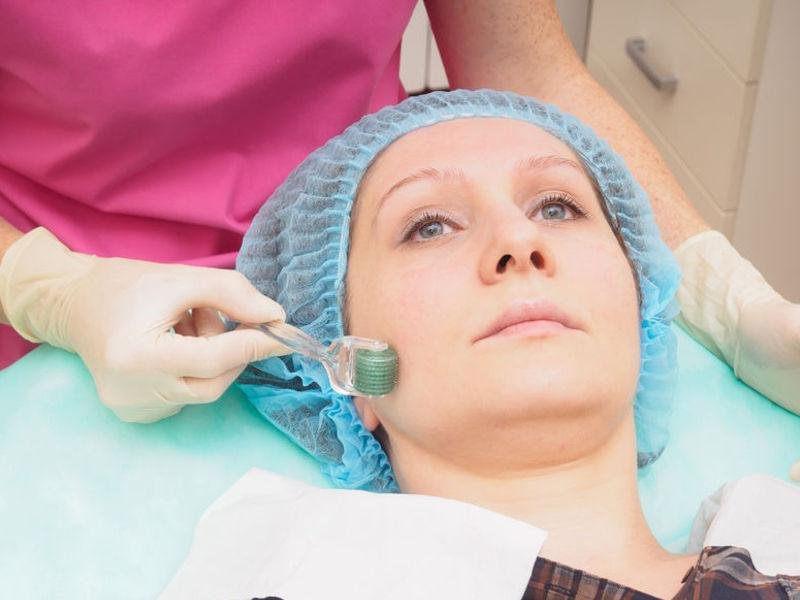 Needling viso: quello che devi sapere per ridurre acne e cicatrici
